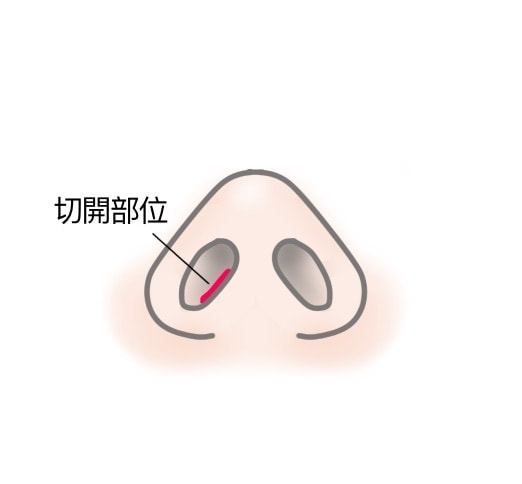 貴族手術、切開部分
