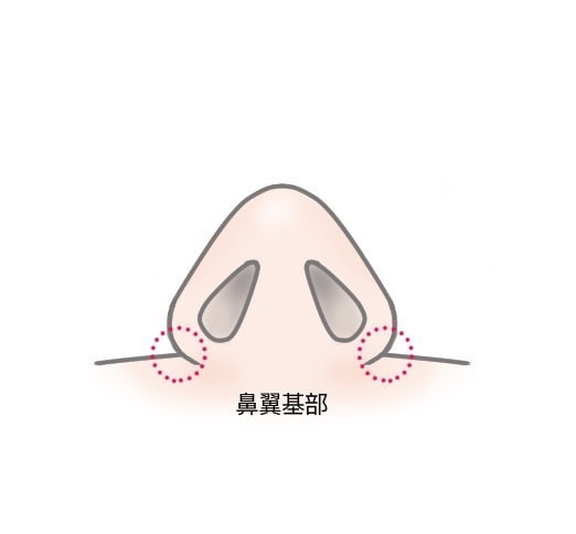 貴族手術、切開部分