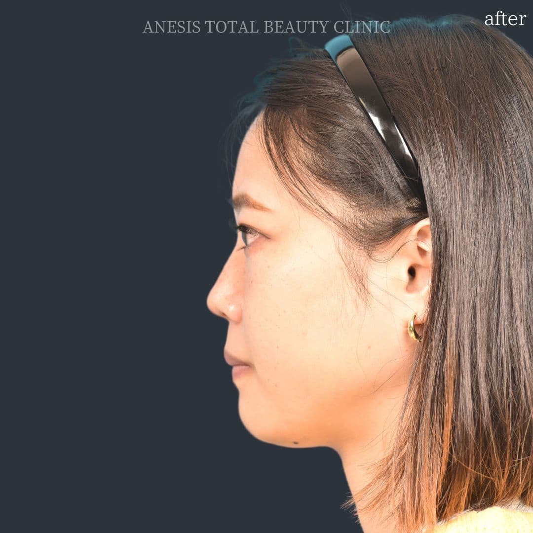 骨切りアフター