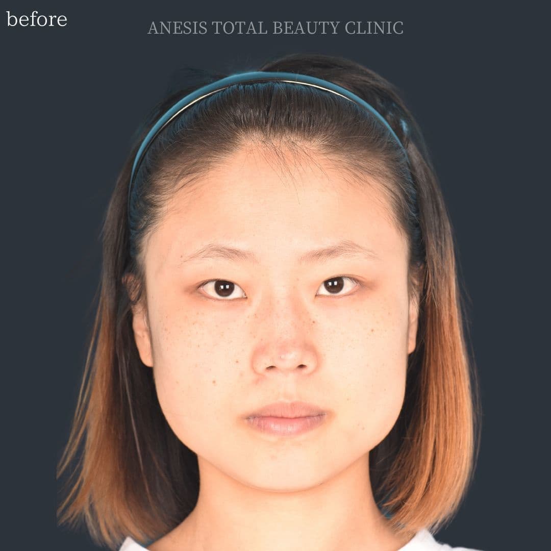 骨切りビフォー