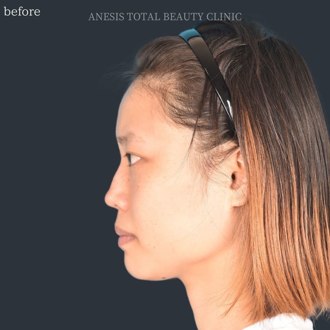 骨切りビフォー