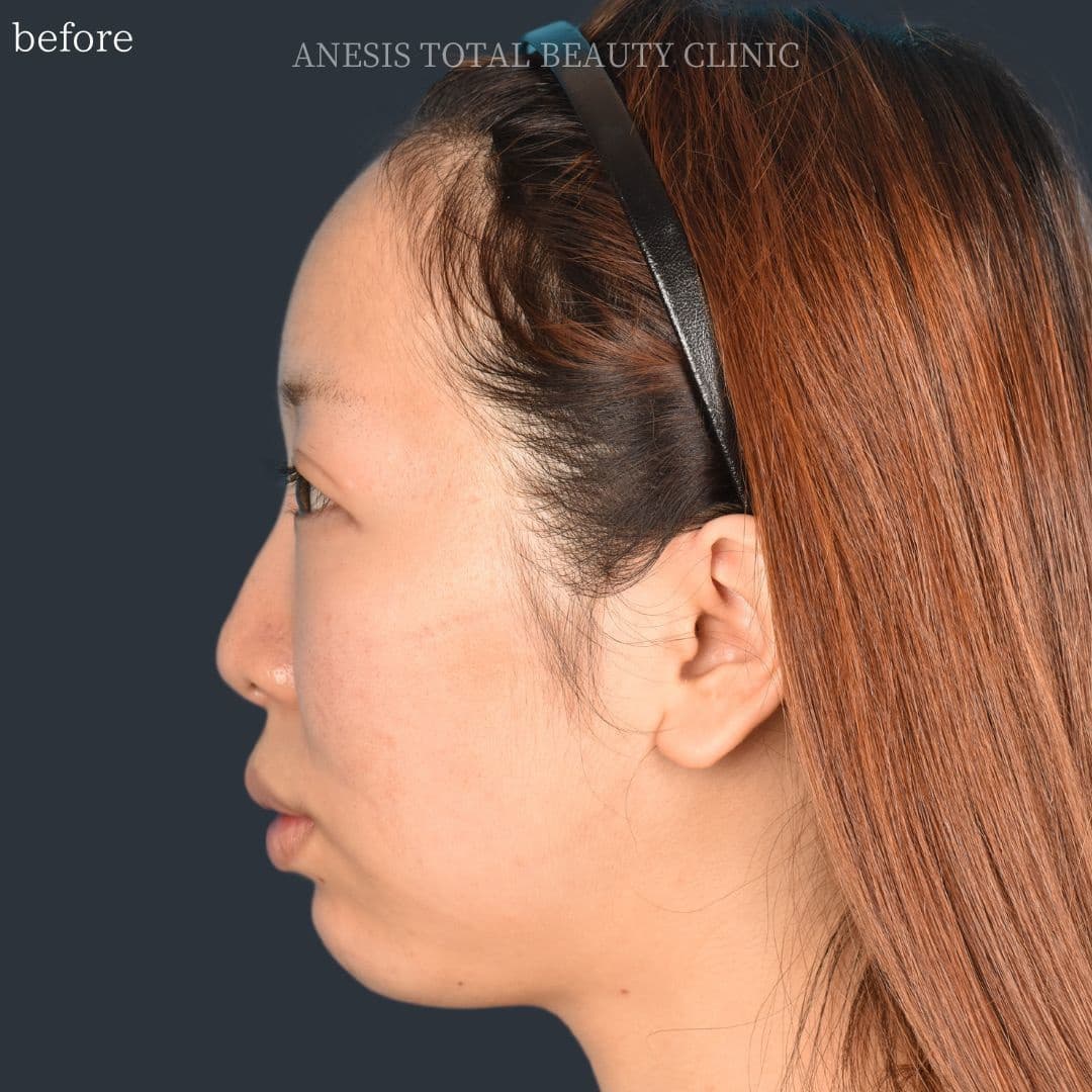 骨切りビフォー