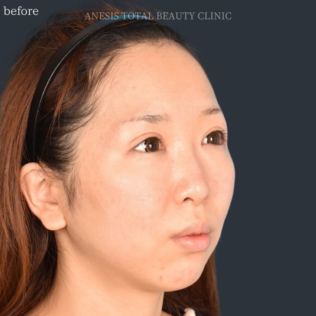 骨切りビフォー