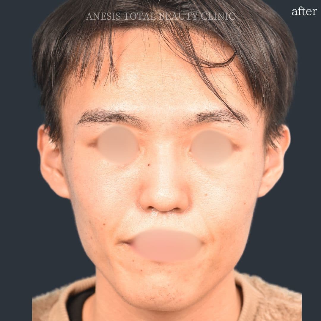 骨切りアフター