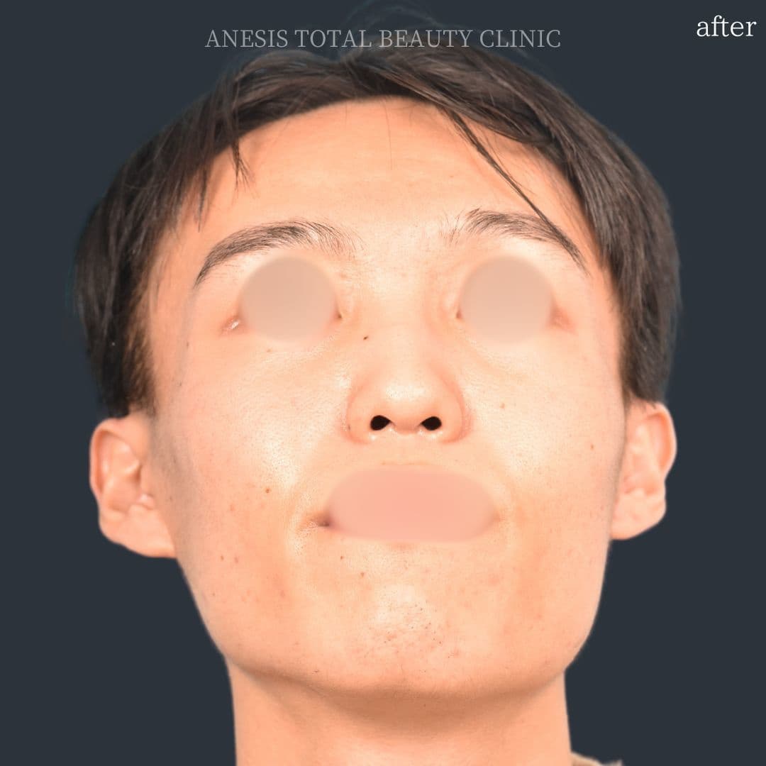 骨切りアフター