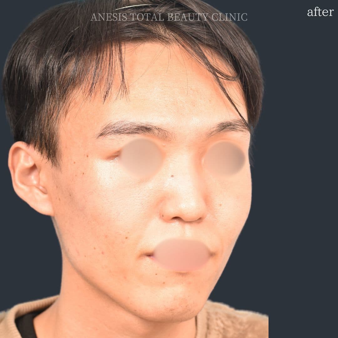 骨切りアフター