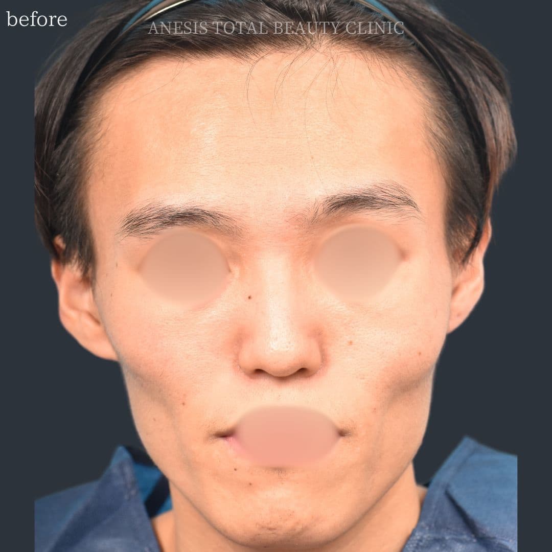 骨切りビフォー