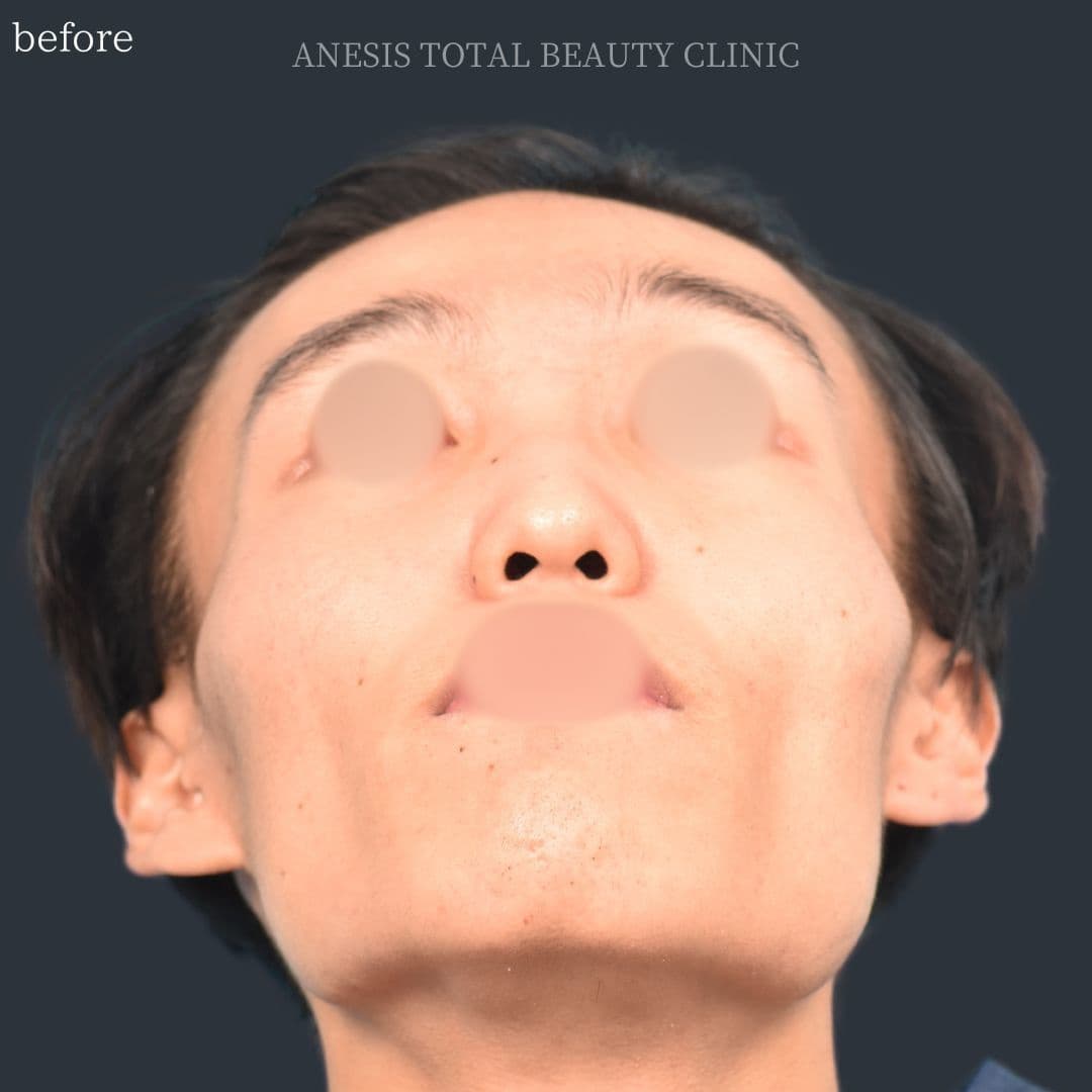 骨切りビフォー