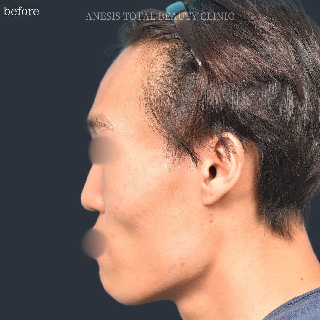 骨切りビフォー