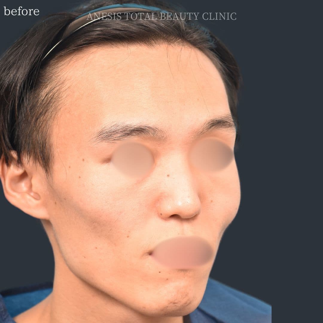 骨切りビフォー