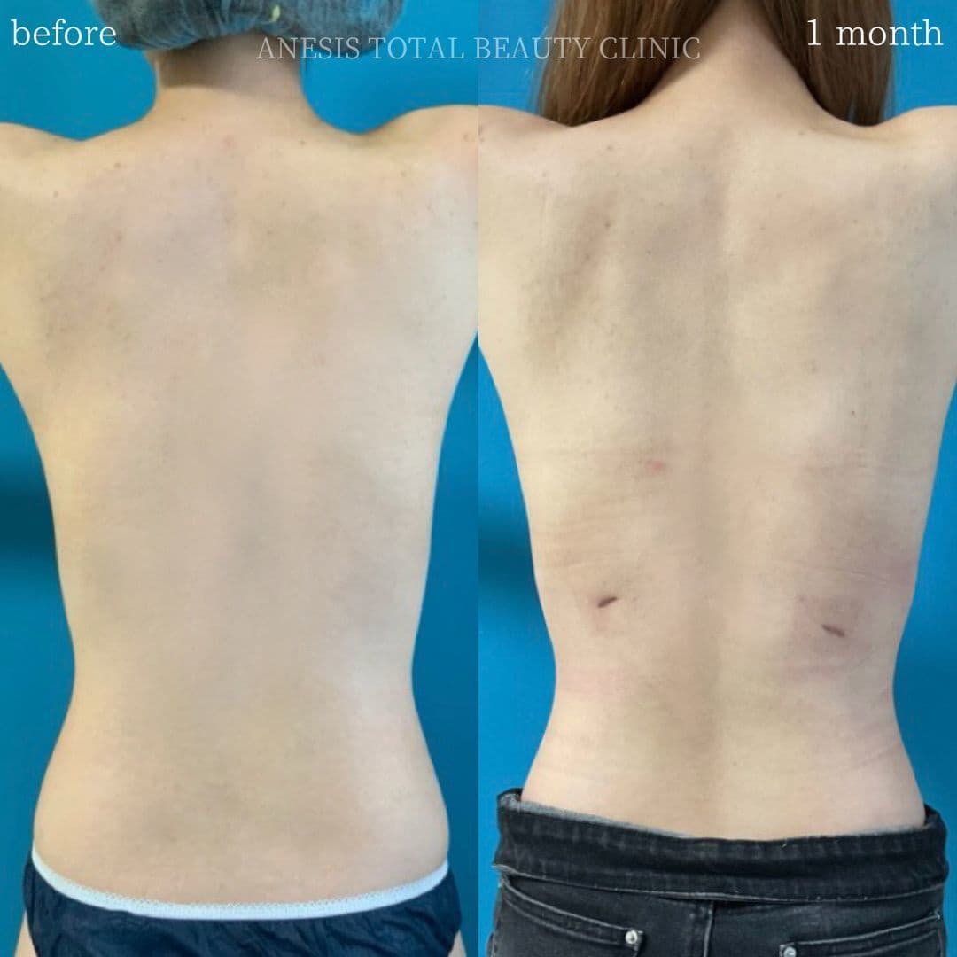 肋骨リモデリング