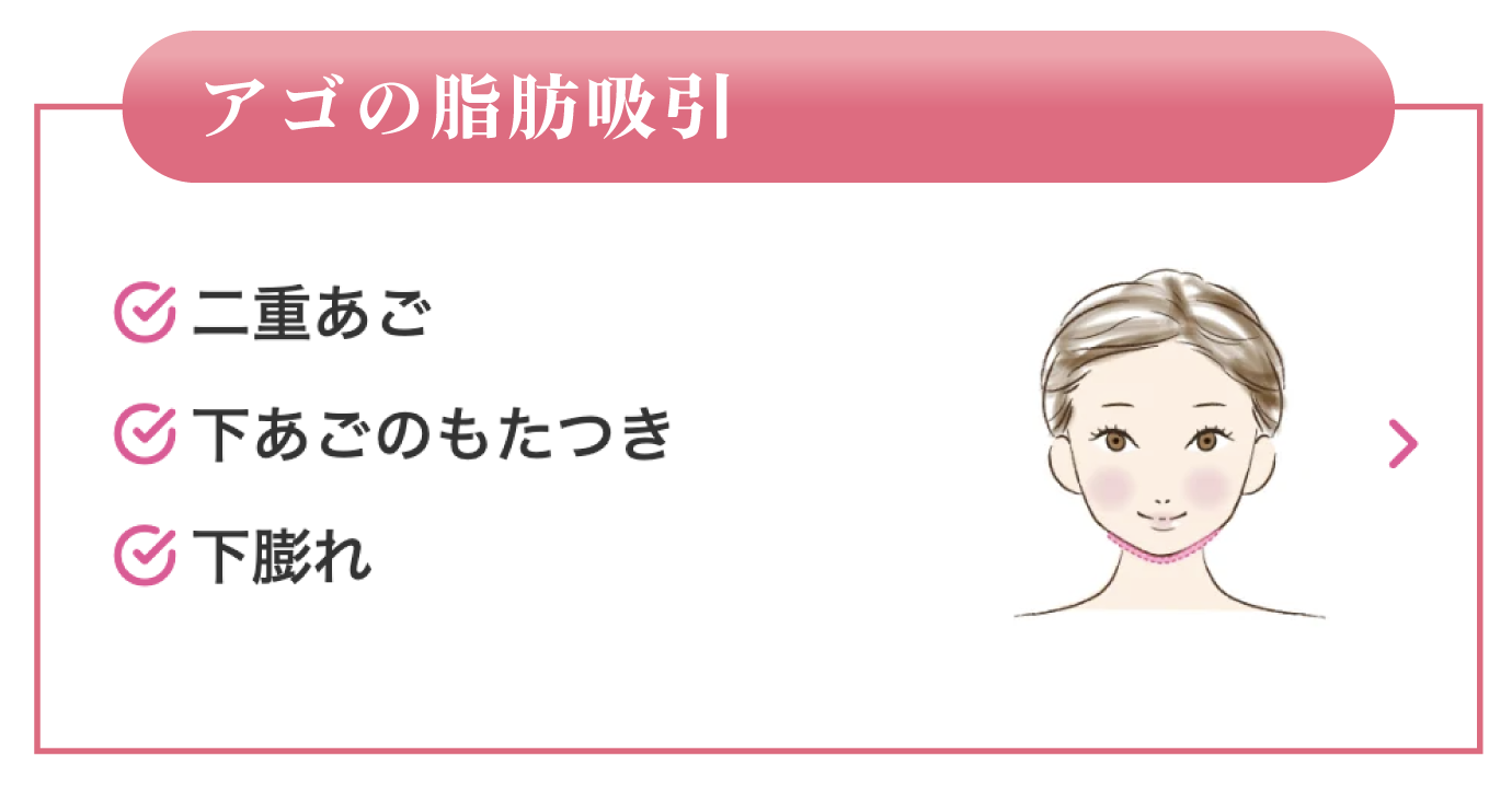 アゴの脂肪吸引