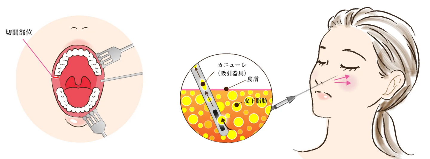切開部位