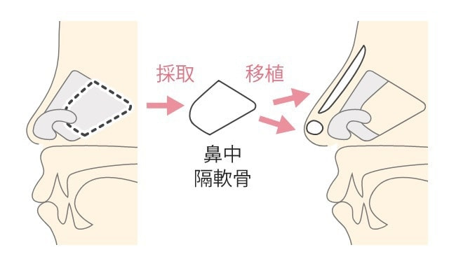 鼻中隔延長