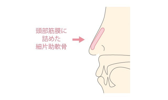 鼻筋と鼻先の形成