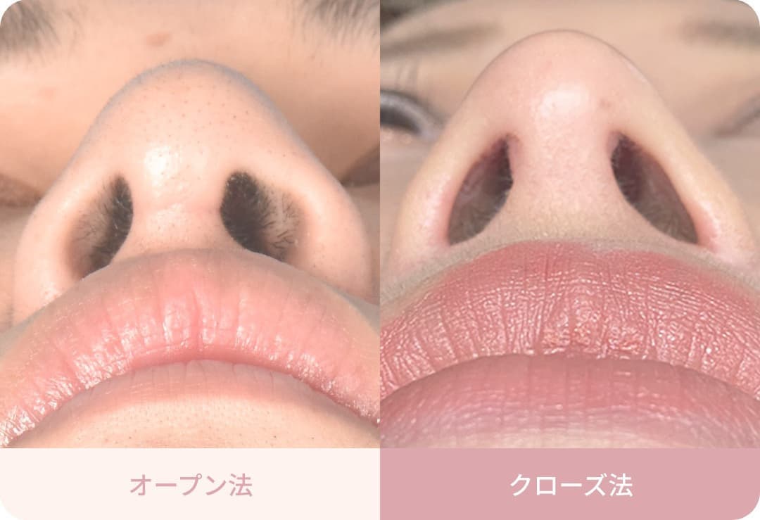 傷跡が残らないクローズ法が可能